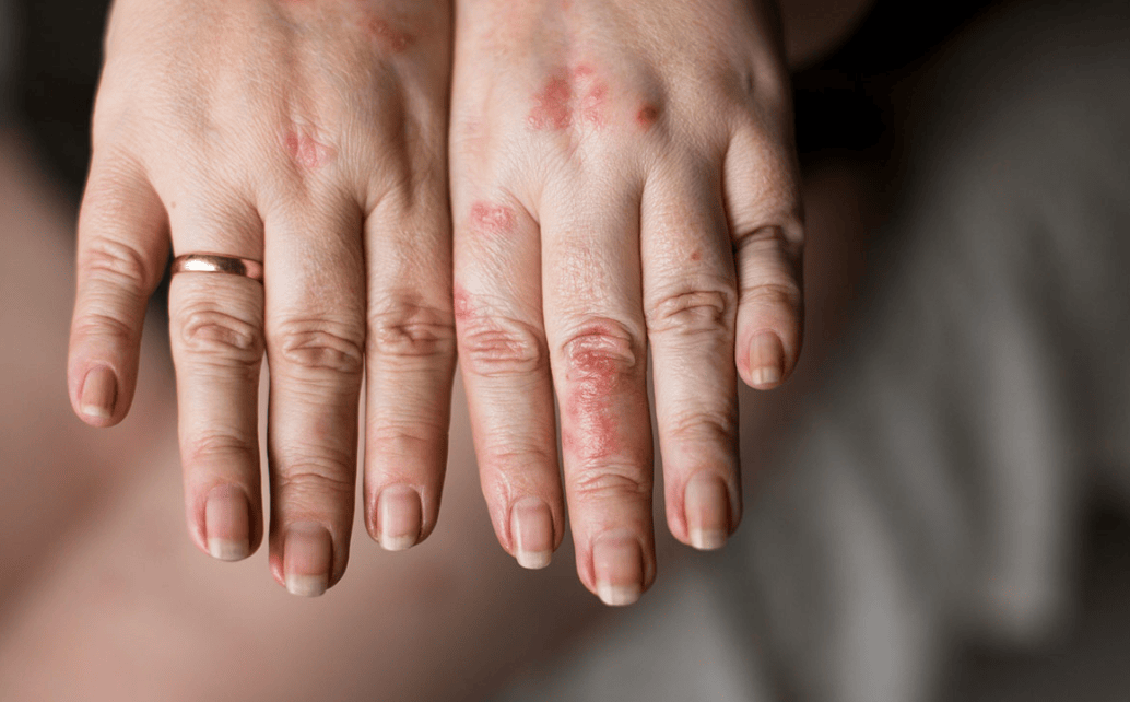seboroični dermatitis